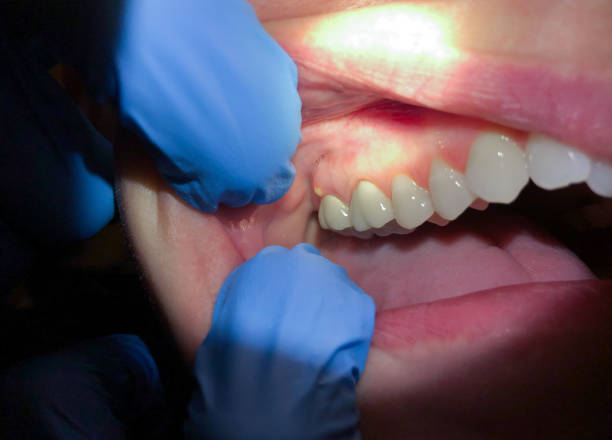 Best Dentist for Tooth Abscess  in Elmwood Park, IL